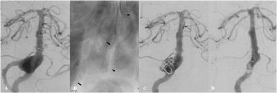 Use of flow diverter device in basilar artery for aneurysm treatment: Case series and literature review